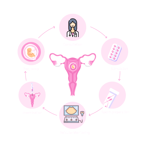 IUI – INTRAUTERINE INSEMINATION – medjinni